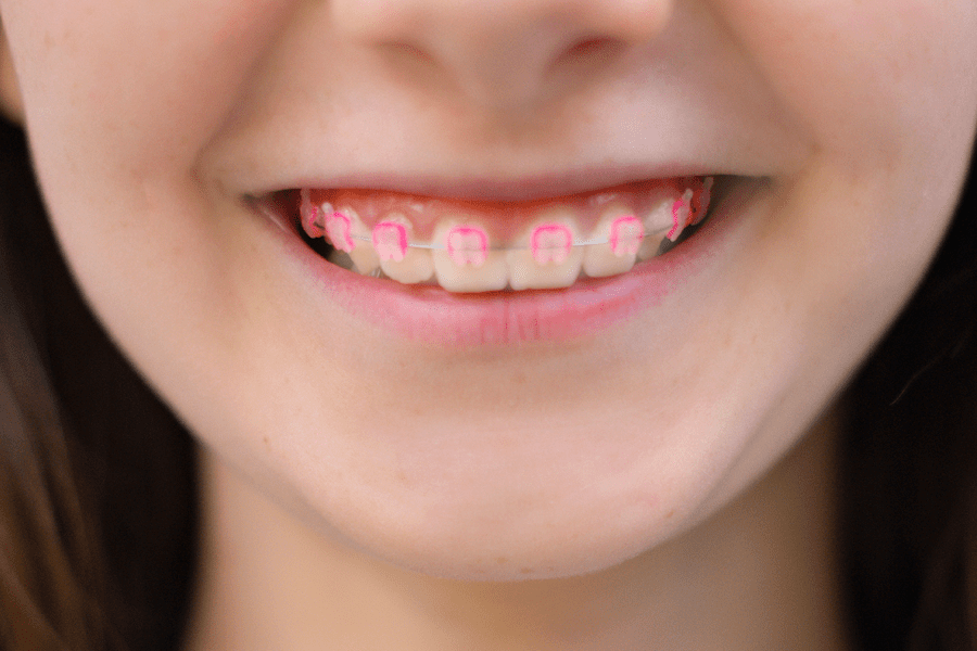 If you have a child with braces, you may want to know if there are ways to get them off faster. Read this article for tips that may reduce the amount of time your child has to wear them.