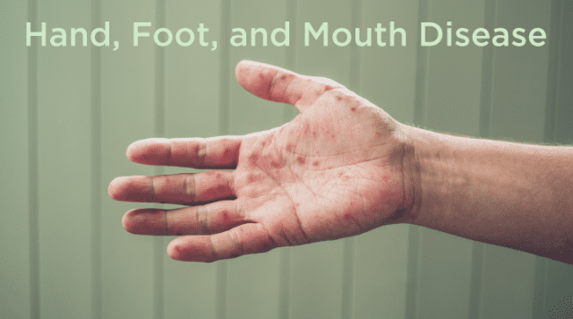 Learn to recognize the symptoms of hand, foot, and mouth disease and how to take action if your child is affected.