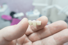 What is a dental bridge? What is a dental bridge procedure? What types of dental bridges are there? Get answers to these and many more questions in this informational dental bridge article.