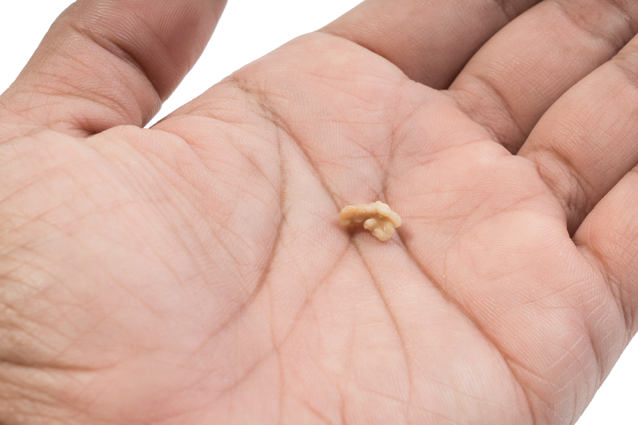 Person holding a tonsil stone.